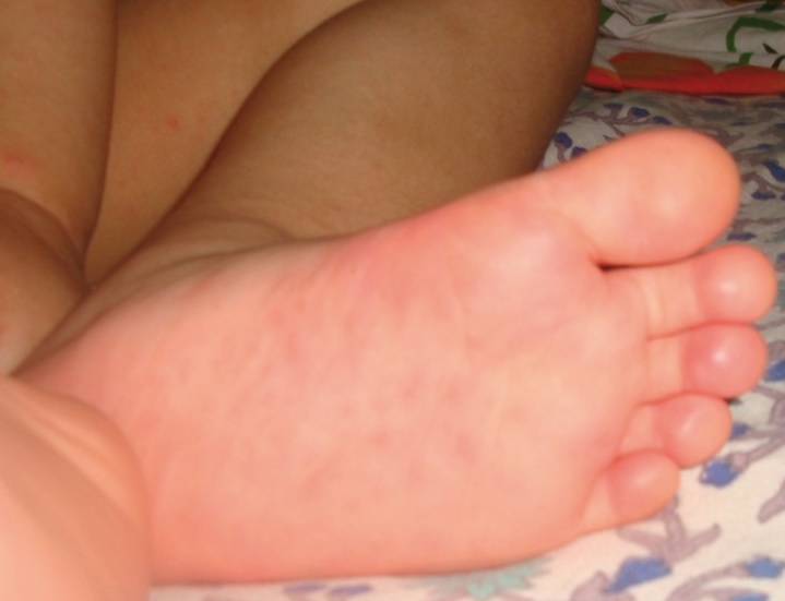 Hand, Foot, and Mouth Disease (HFMD) atau penyakit tangan kaki mulut adalah penyakit yang disebabkan oleh virus dari genus Enterovirus.Dok. National Library of Medicine