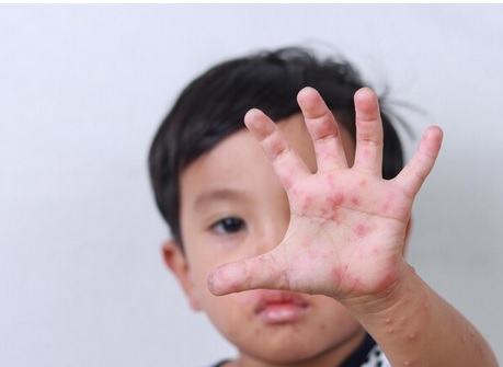 Kerap Dialami Anak-anak, Kenali Tanda-tanda Penyakit HFMD