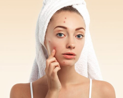 7 Kandungan Skincare Terbaik untuk Mengatasi Jerawat