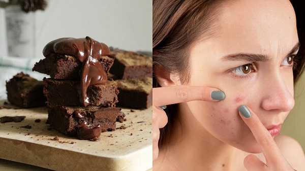 Benarkah Cokelat Menyebabkan Jerawat? Ini Faktanya