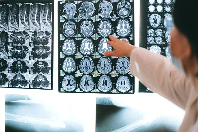 Selain Hipertensi, 5 Penyebab Lain Bisa Akibatkan Perdarahan Otak