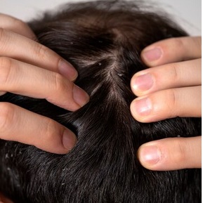 5 Alasan Mengapa Ada Benjolan di Kulit Kepala, Salah Satunya Kutu Rambut