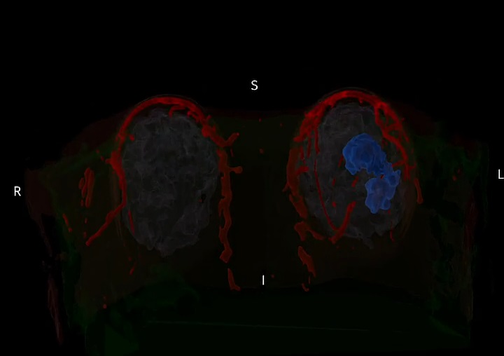 Teknologi AI Bantu Ahli Bedah Bidik Kanker Payudara