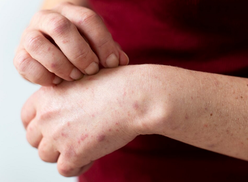 Ketahui Mitos, Fakta dan Stigma Sosial Seputar Penyakit Kusta Menurut Ahli