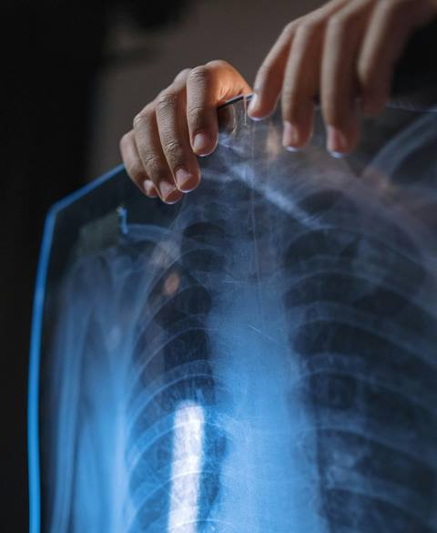 3 Langkah Cegah TB Paru