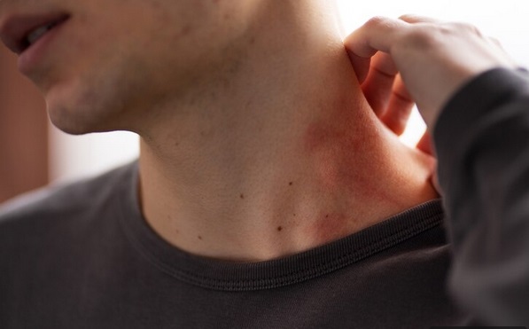 Jangan Sepelekan! Cacar Api Dapat Sebabkan Komplikasi Ini