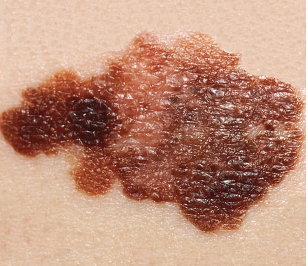 Bukan Sekadar Tahi Lalat Biasa, Ini Penjelasan Melanoma Si Kanker Kulit