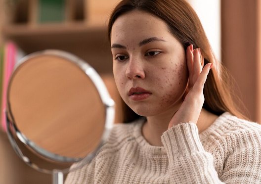 4 Cara Mengatasi Jerawat Jika Memiliki Kulit Kering