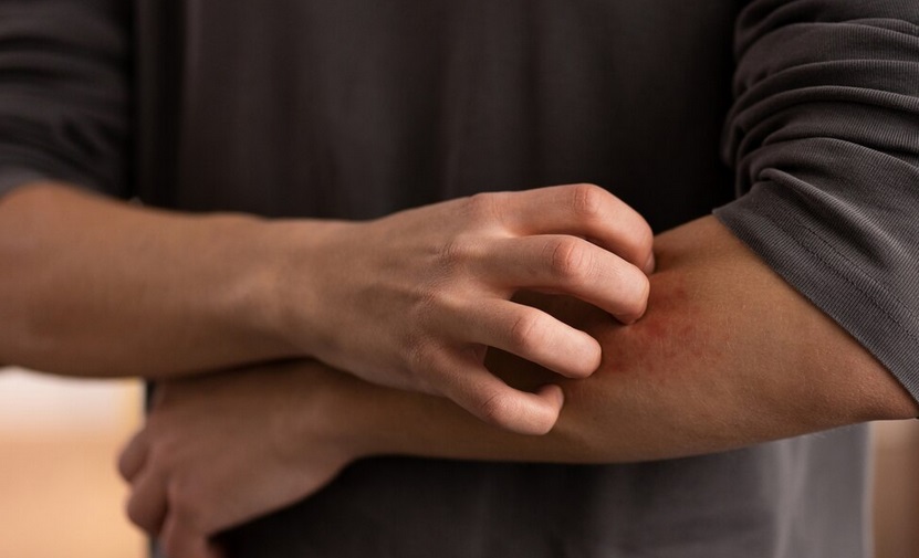 Dermatitis atopik sayangnya tidak cocok dengan beberapa kandungan produk pembersih. Ilustrasi Freepik