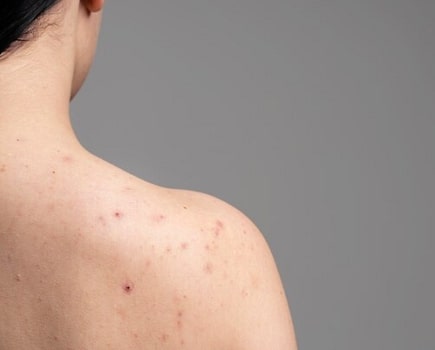 Ketahui, 6 Kebiasaan ini Sebabkan Jerawat di Punggung