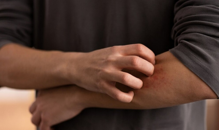 Pria Ini Muncul Moluskum akibat Thifting Pakaian, Kenali Gejalanya