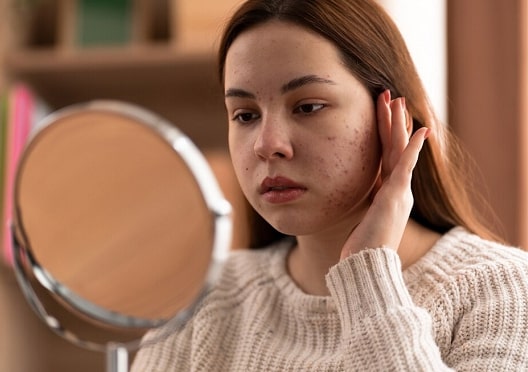 <i>Ladies</i>, Catat! Begini Cara Samarkan Jerawat dan Bekasnya dengan Make Up