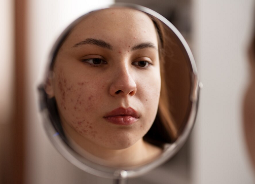 Komedo Masih Membandel, Apakah karena Pembersih Wajahnya Tidak Berfungsi?