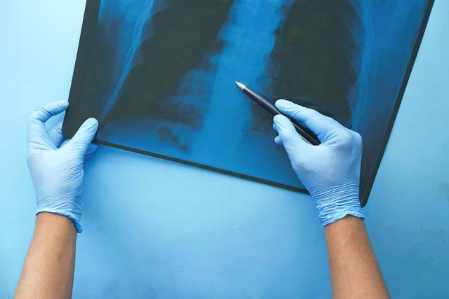 Indonesia telah menyelesaikan proses rekrutmen partisipan untuk uji klinik fase 3 kandidat vaksin Tuberkulosis (TBC) M72. (Foto: Ilustrasi/Dok. Pexels.com)