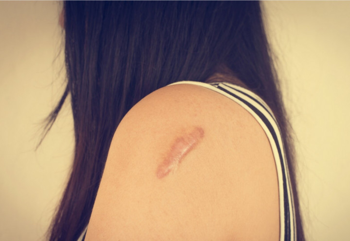 Kerap Mengganggu Penampilan, Begini Cara Menghilangkan Keloid