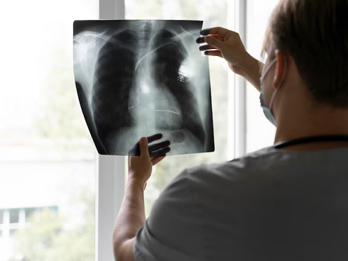 Penyebab Kematian Nomor 1, POTI Perkuat Langkah Nasional Tangani Kanker Paru