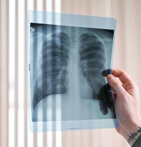 Sebanyak 99 Jemaah Haji Indonesia Dilaporkan Terserang Pneumonia