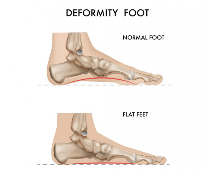 Mengenal Kondisi Kaki Rata, Penyebab, dan Jenisnya