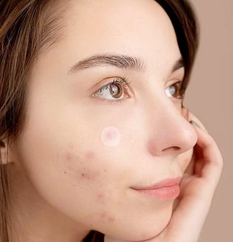 Ilustrasi acne patch. Foto: Instagram/@onlyshaperz