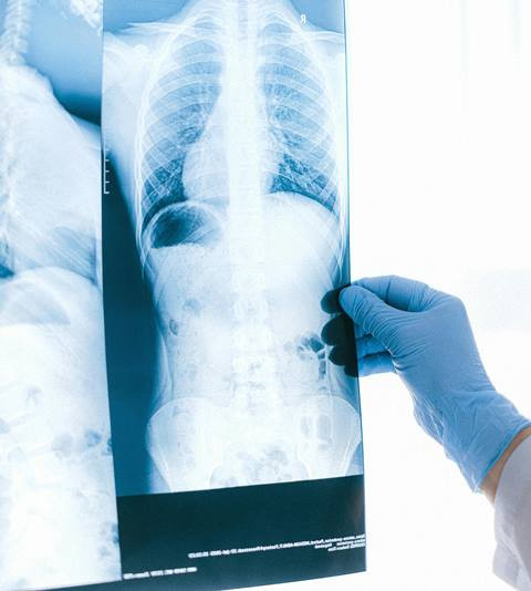 TB Milier, TBC yang Bukan Hanya Batuk dan Berat Badan Turun