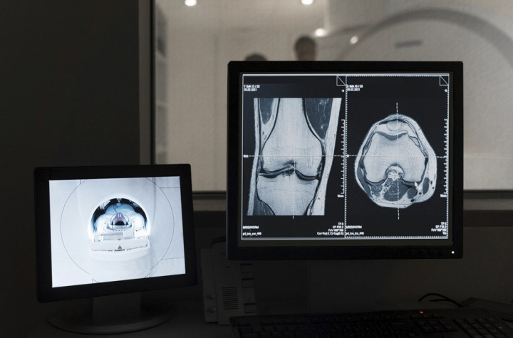 Siapa yang Sebaiknya Menerima Operasi Lutut? Dokter Beri Jawaban Ini