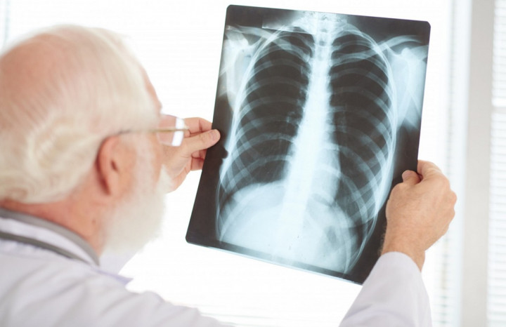 TBC Makin Meresahkan, Ini 4 Cara Mencegahnya