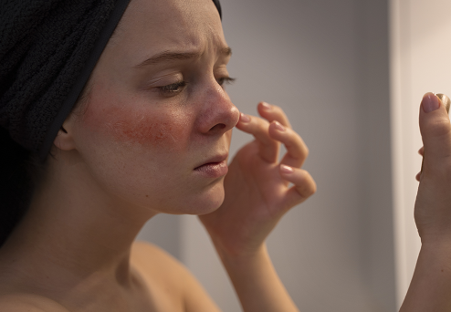 7 Cara Mengatasi Skin Barrier yang Rusak Rekomendasi Ahli