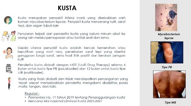  Upaya eliminasi kusta terus dilakukan dan ini dibahas dalam eliminasi kusta di Bali dengan SHF dan WHO. (Foto: Dok. Birkom Kemenkes)