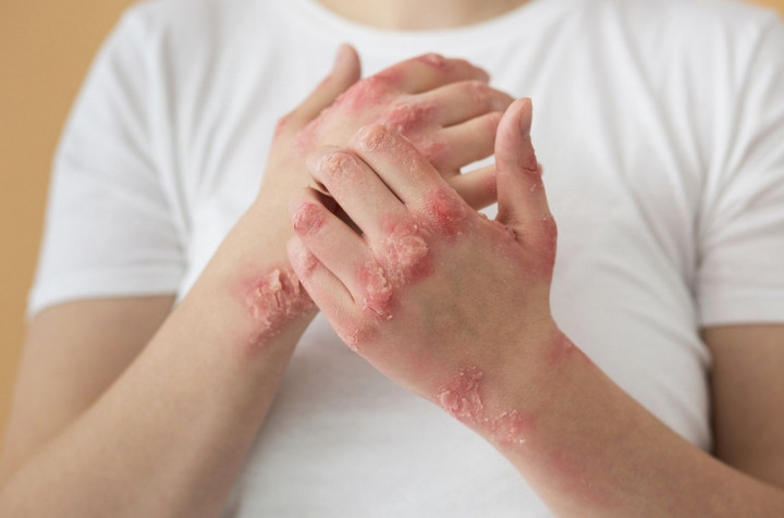 5 Jenis Alergi Kulit yang Sering Terjadi