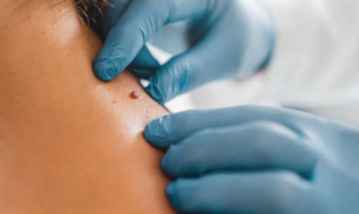 Pada Usia Berapa Tahi Lalat Muncul?