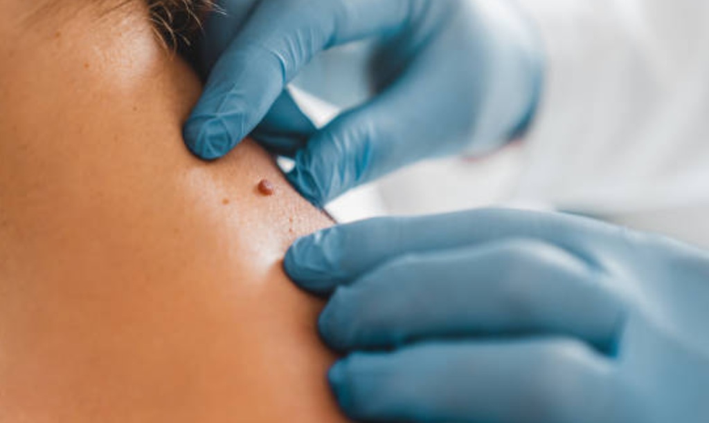Tahi lalat, atau nevus, bisa muncul kapan saja selama hidup. Ilustrasi Pexels