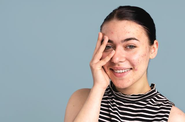 6 Bahan untuk Bantu Hilangkan Noda Hitam Bekas Jerawat