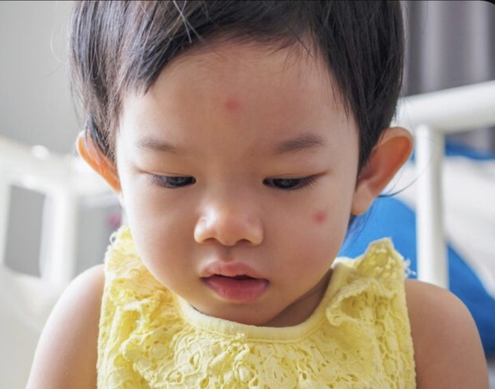 Mengenal Urtikaria Papular, Ruam yang Sering Muncul di Kulit Anak