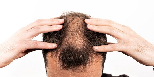 Stres Picu Kebotakan, Dosen IPB Ungkap Penyebabnya