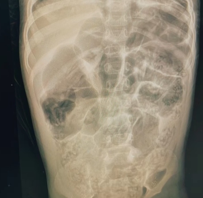 Tampilan CT Scan tubuh Raya. Bayi berusia 4 tahun yang tewas karena infeksi cacing gelang. Dok. Screenshoot rumah_teduh_sahabat_iin 