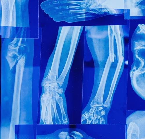 Awas, Tulang Bisa Melemah Akibat 5 Makanan dan Minuman Ini