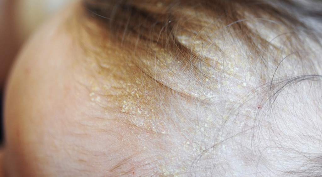 Penting untuk diketahui bahwa cradle cap tidak berbahaya dan tidak menular. Dok. Babycenter