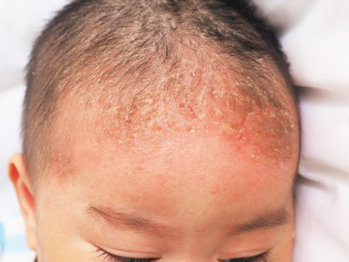 Cara Aman Mengatasi Cradle Cap pada Bayi dengan Minyak Alami