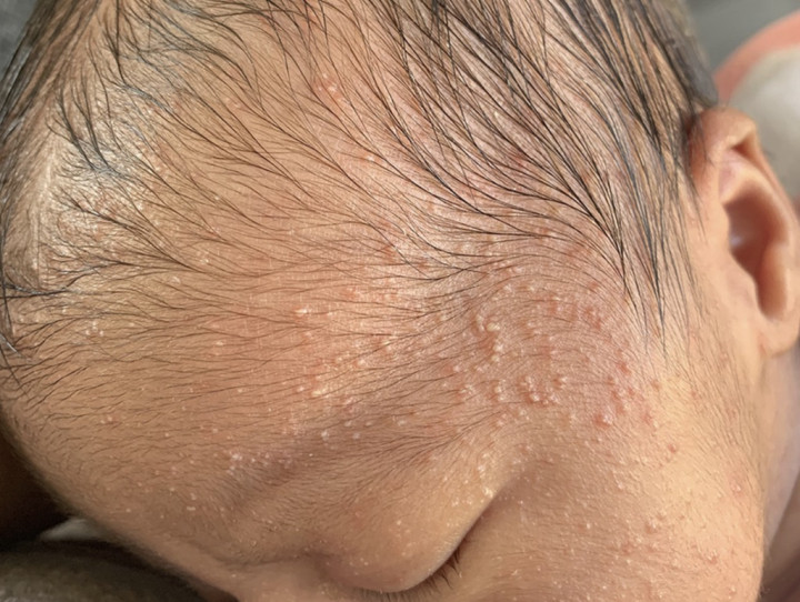 Moms Harus Tahu! Ini Penyebab Jerawat pada Bayi Baru Lahir