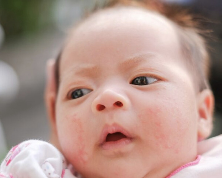 Kapan Jerawat Bayi Perlu Perawatan Medis?