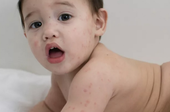 Gejala dan Penyebab Cacar Air pada Bayi