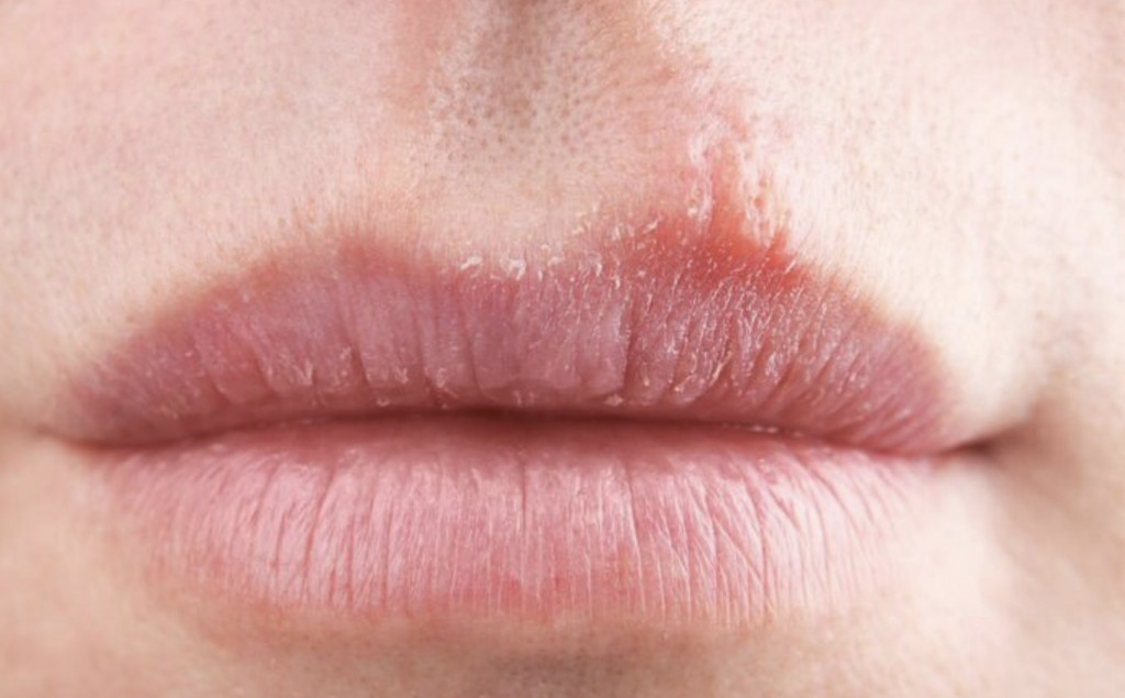 Sebenarnya luka ini biasanya sembuh sendiri dalam waktu singkat tanpa perlu intervensi medis yang rumit. Ilustrasi Freepik