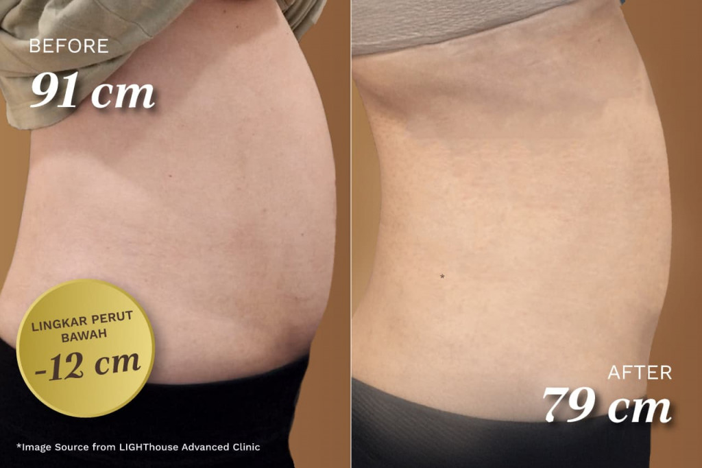 Prosedur Ulfra Lift. Foto: LIGHThouse advanced clinic