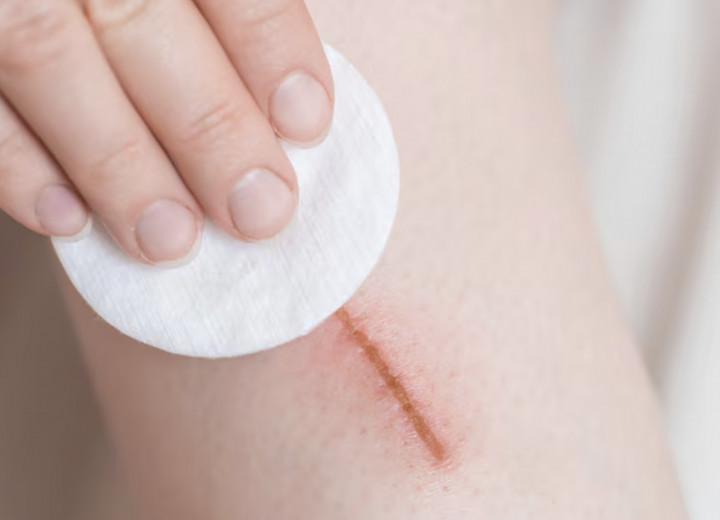 Masih Banyak Salah Kaprah soal Perawatan Luka, Ini Penjelasan Dokter