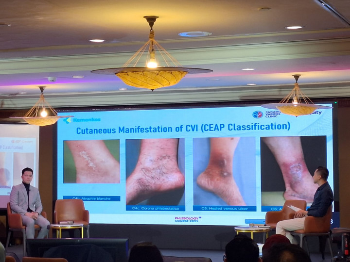 Upaya Meningkatkan Pemahaman Nakes Terhadap Penyakit Varises