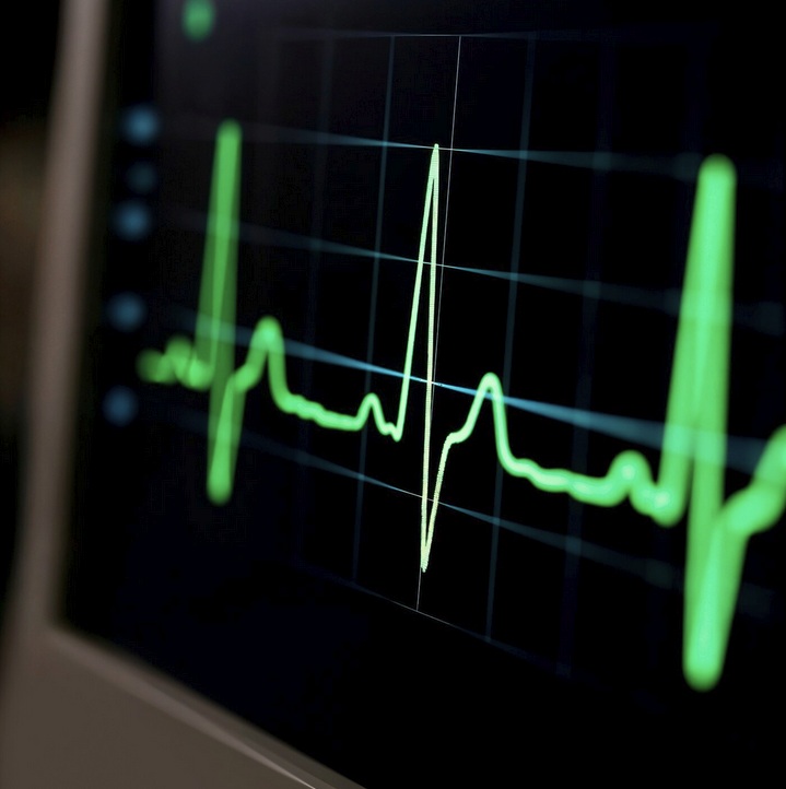 Atrial Fibrillation jadi Pemicu Stroke, Ini Pentingnya Periksa Nadi Rutin
