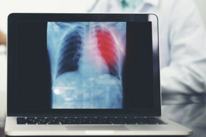 Hipertensi Paru, Penyakit Mematikan yang Sering Terdiagnosis Terlambat di Indonesia