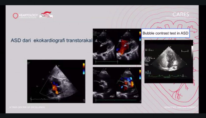  Heartology Cardiovascular Hospital berhasil melakukan tindakan MICS. (Foto: Dok. Istimewa)