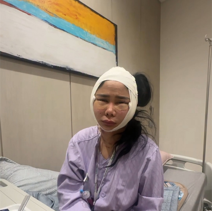 Tiga Tahun Tak Urus Diri, Denise Chariesta Operasi Plastik Rp1 Miliar