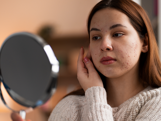 5 Rekomendasi Skincare untuk Kulit Berjerawat, Harga di Bawah Rp100 Ribu